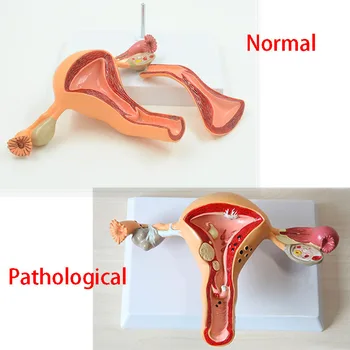 De medische Wetenschap Normaal/Pathologische Baarmoeder Eierstok Anatomische Model Anatomie doorsnede Medisch onderwijs levert